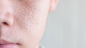 Saran Dokter, Inilah Cara Mengecilkan Pori-Pori Wajah yang Aman